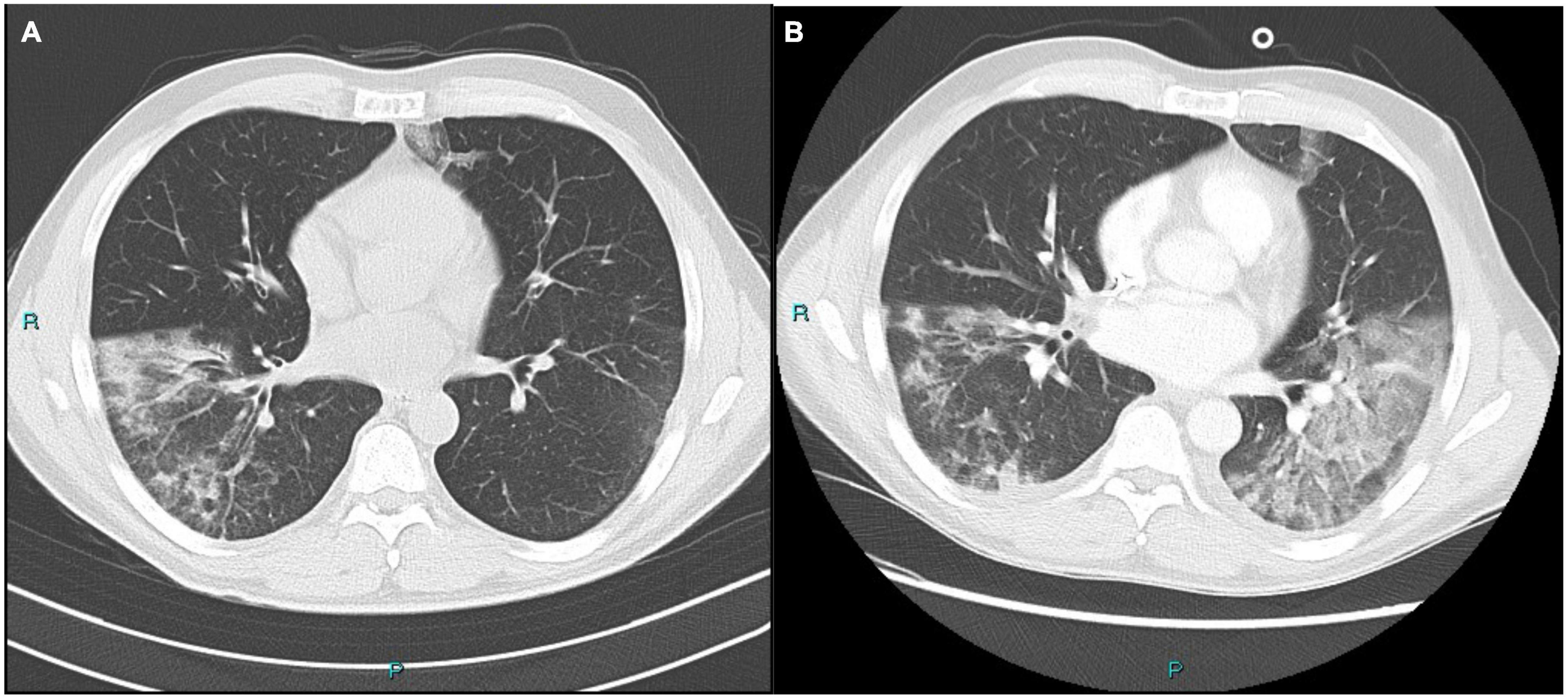 Case report: Sotrovimab, remdesivir and nirmatrelvir/ritonavir combination as salvage treatment option in two immunocompromised patients hospitalized for COVID-19